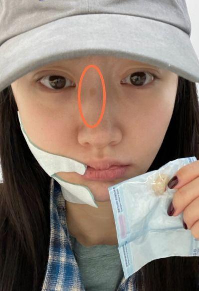 明星网红拔智齿图片高清,高清图片揭秘口腔美容新潮流