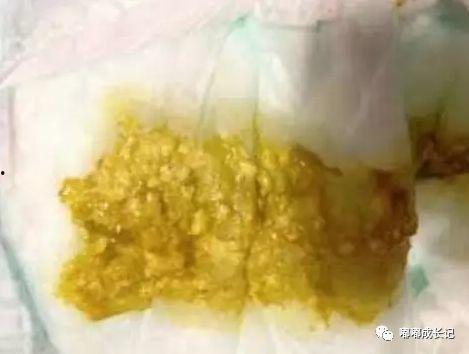 吃二甲双瓜拉肚子大便黑,腹泻黑便警示录”