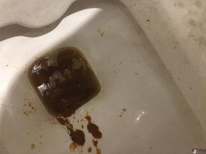 吃二甲双瓜拉肚子大便黑,腹泻黑便警示录”